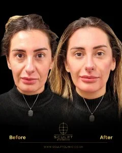 Model before and after Facial Proportions