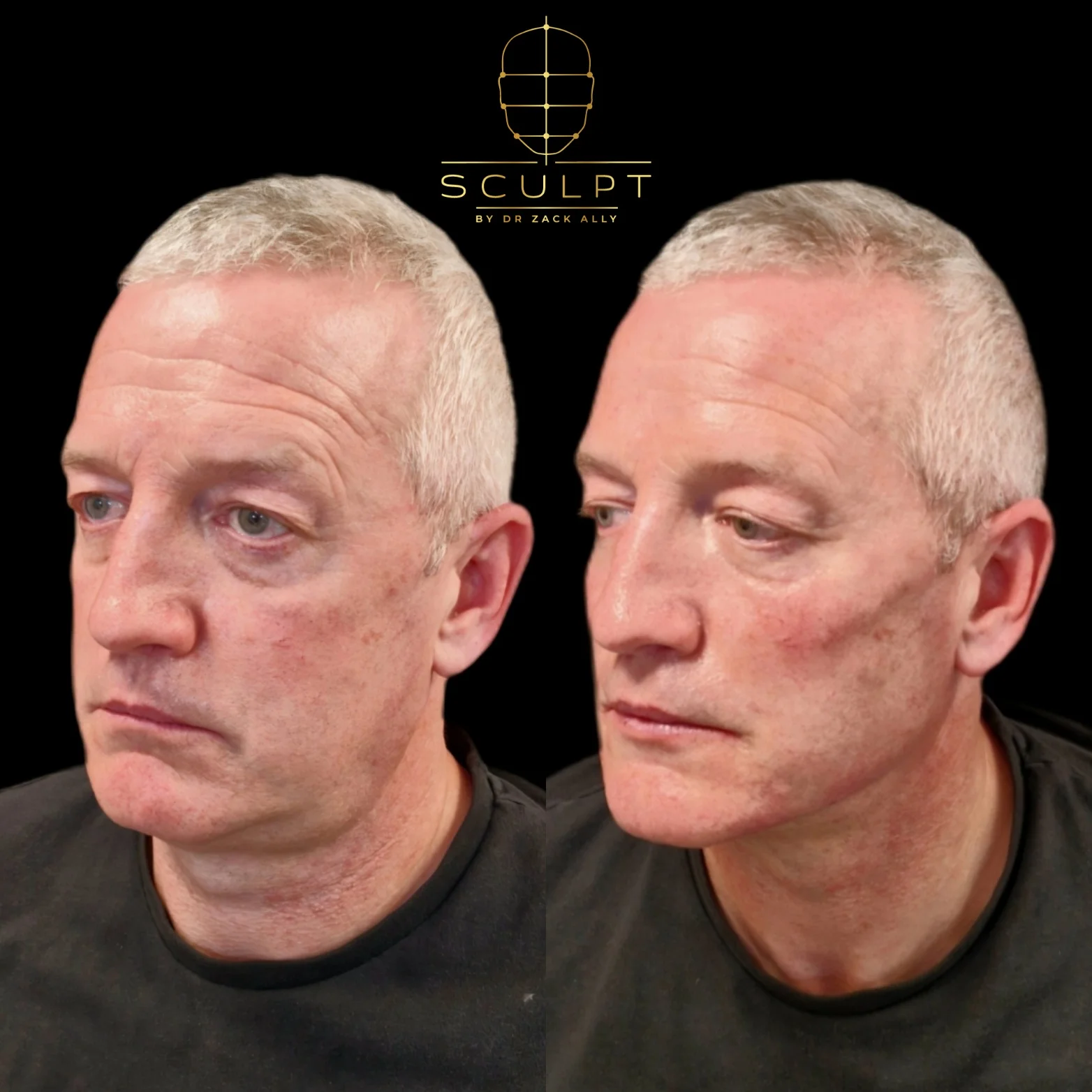 A male patient before and after his treatment at Sculpt Clinic