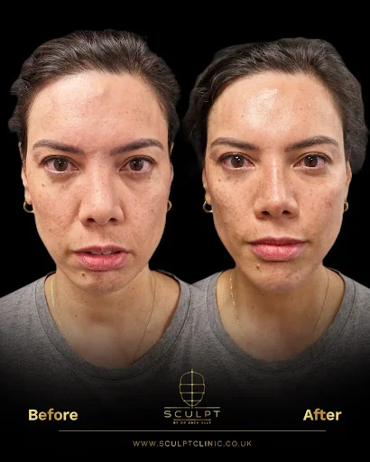 Botox Injection Treatment Female Before and After Procedure Results