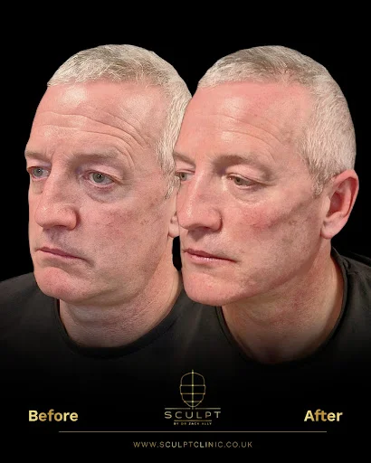 Botox Injection Treatment Male Before and After Procedure Results