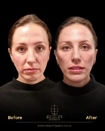 Female results after botox treatment