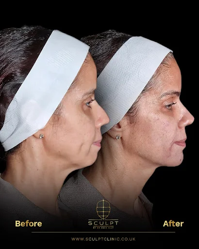Result form a female patient before and after botox treatment