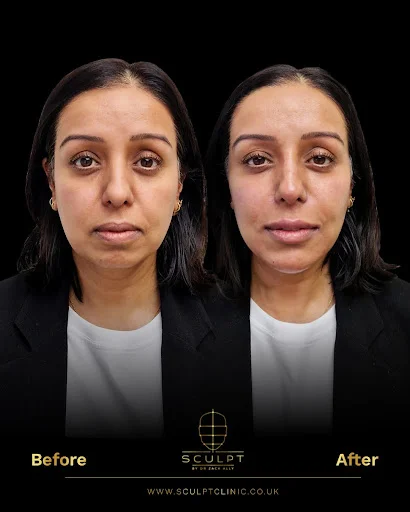 Results from botox treat before and after