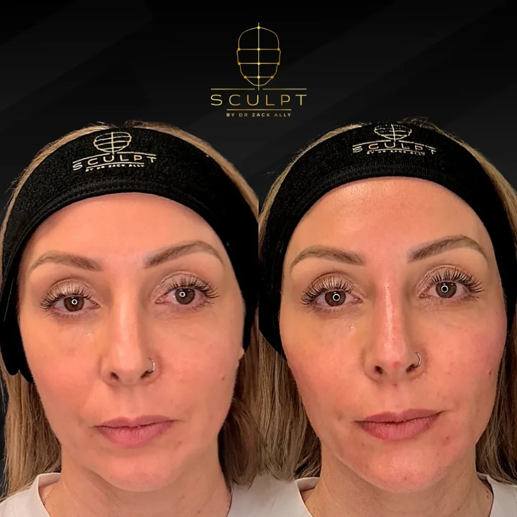 Before and after with Sculpt Clinics Skin Care Treatment London